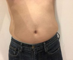 ぽっこりお腹の脂肪